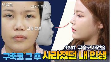feat. 구축코 재건술 구축코 그 후 사라졌던 내 인생