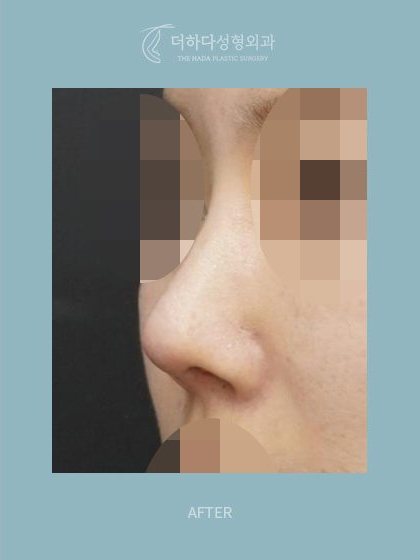 구축코 재건,자가늑 코재수술 수술 후(AFTER) 45도