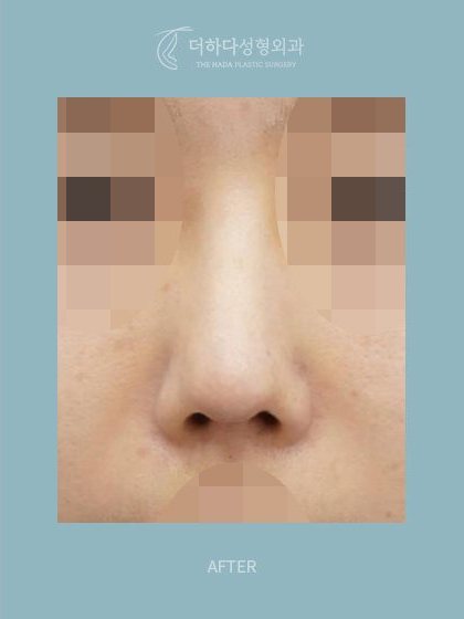 구축코 재건,자가늑 코재수술 수술 후(AFTER) 정면