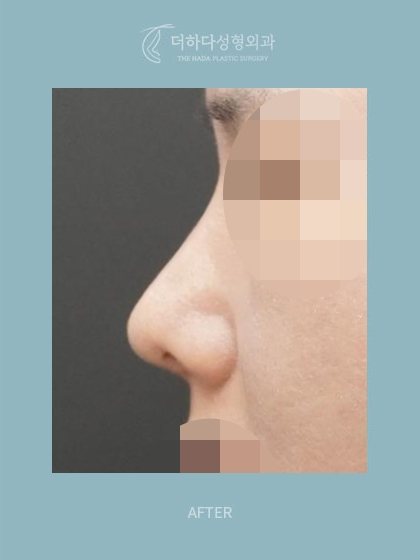구축코 재건,자가늑 코재수술 수술후 3개월(AFTER) 옆모습