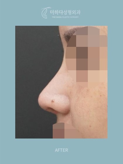 구축코 재건,자가늑 코재수술 수술후 3개월(AFTER) 옆모습