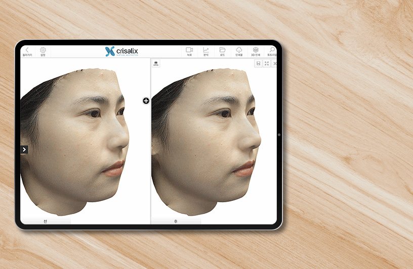 나무 책상 위 크리살릭스 가상성형 전후 3D 얼굴 화면 태블릿