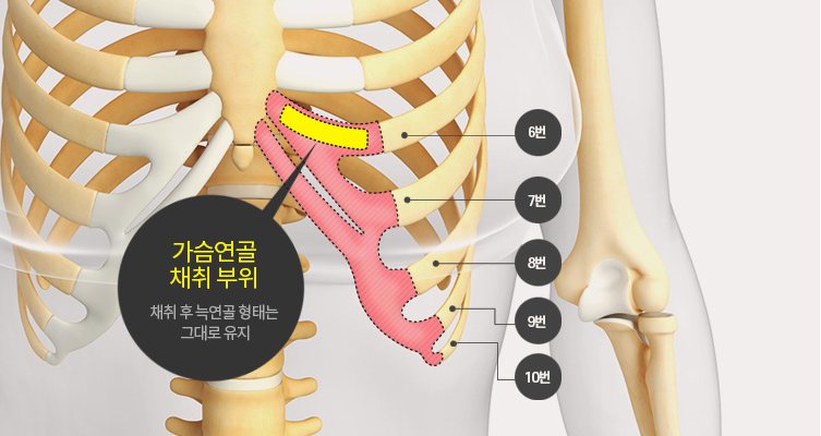 가슴연골(늑연골) 채취 부위 도식 — 6~10번 갈비 연골