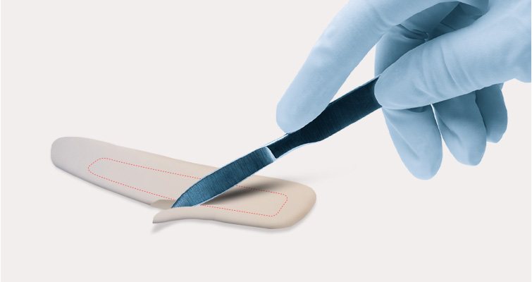 장갑 낀 손이 수술칼로 연골 조각을 다듬는 장면