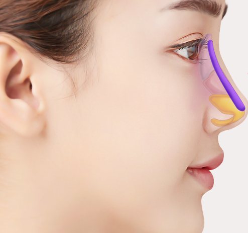 코 옆모습 위 삽입된 보형물(보라)·코끝(노랑) 표시와 제거 화살표 도식