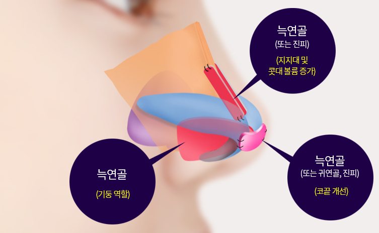 콧대·코기둥·코끝에 늑연골을 넣는 위치 도식(남색 원 설명 3개)