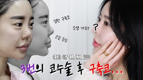 3번의 코수술 후 구축코...