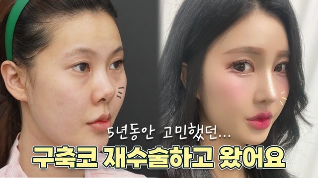 5년동안 고민했던... 구축코 재수술하고 왔어요