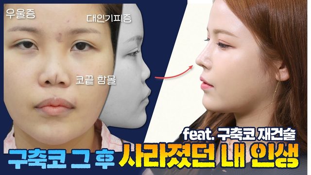 feat. 구축코 재건술 구축코 그 후 사라졌던 내 인생